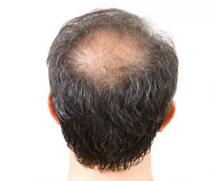 Alopecia Areata