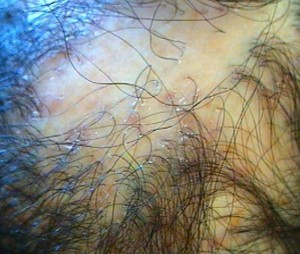 Cicatricial Alopecia: World Trichology Society