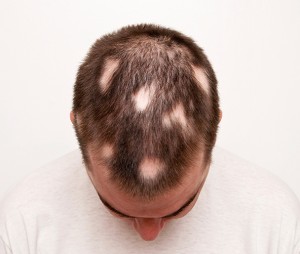 alopecia areata